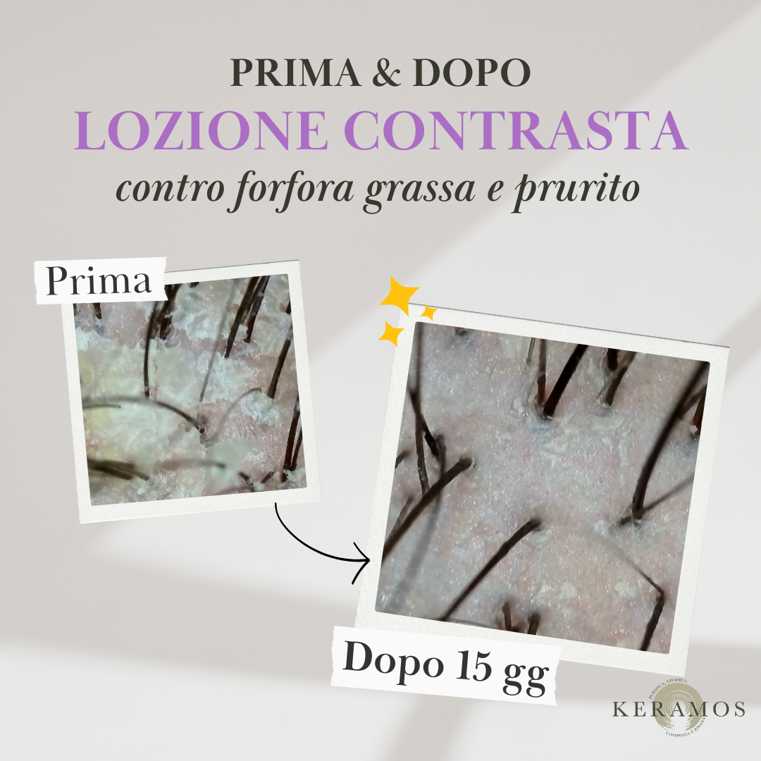 CONTRASTA lozione spray per forfora grassa