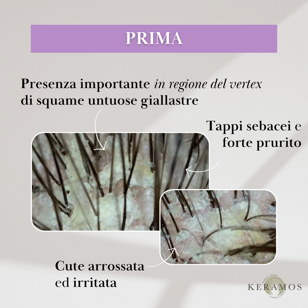 CONTRASTA lozione spray per forfora grassa