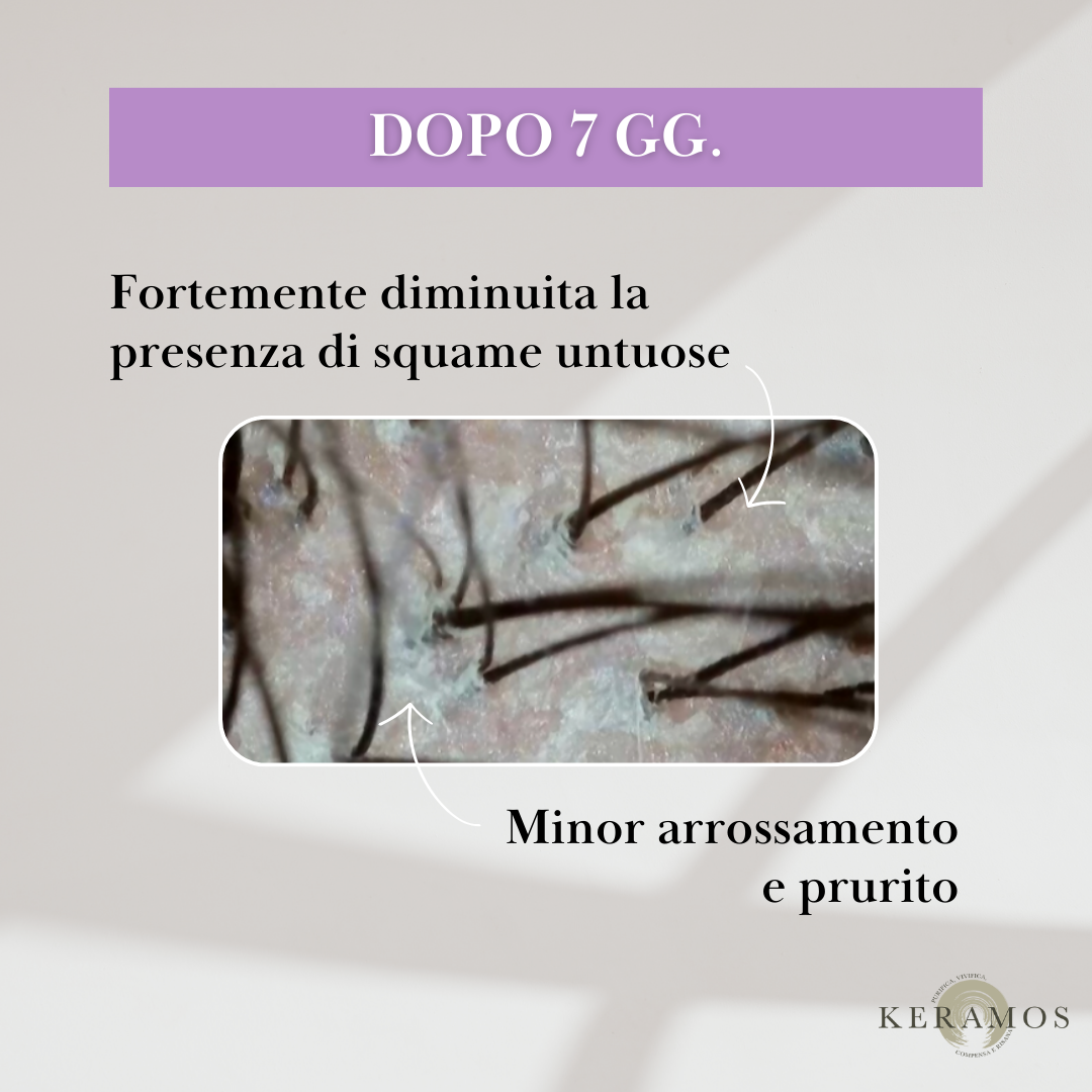 CONTRASTA lozione spray per forfora grassa