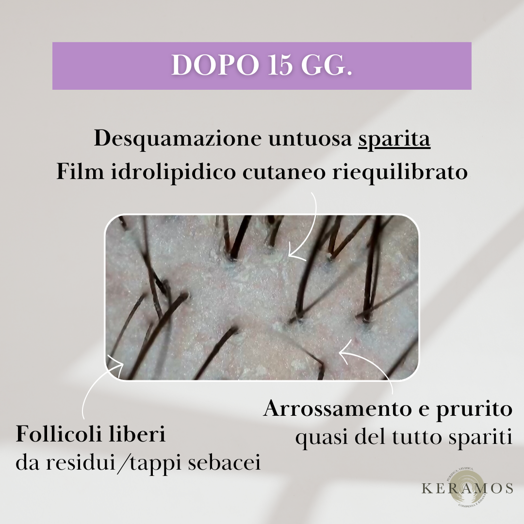 CONTRASTA lozione spray per forfora grassa